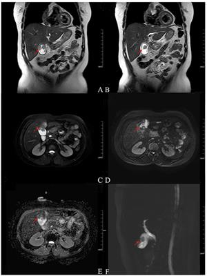 Attempt of Real-Time Near-Infrared Fluorescence Imaging Using Indocyanine Green (ICG) in Radical Resection of Gallbladder Cancer: A Case Report